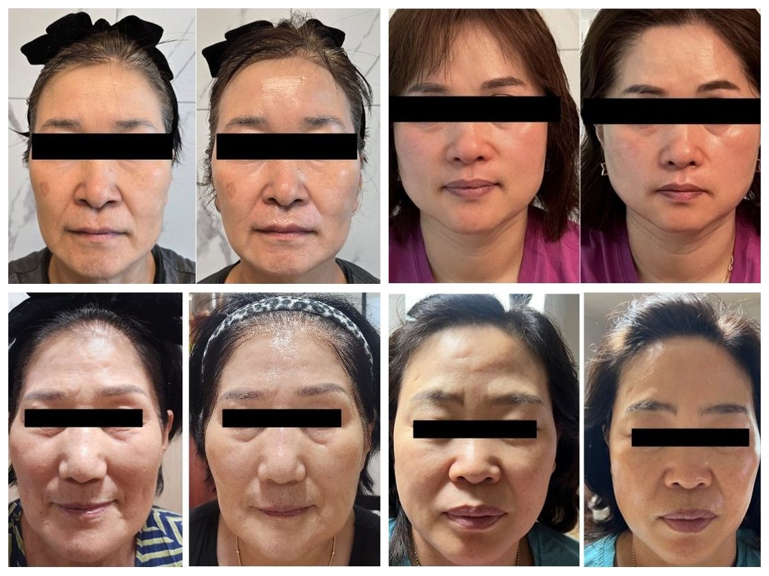더마아키텍트 체험 전후 사진 모음